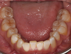 Mindy H. - 3 months into treatment