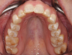 Mindy H. - 3 months into treatment