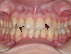 Rebekah H. - 7 weeks into treatment