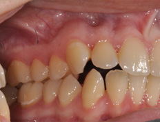 Rebekah H. - 7 weeks into treatment