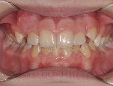 Hailey W. - 8 months into treatment