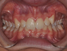 Austin C. - 5 months into treatment